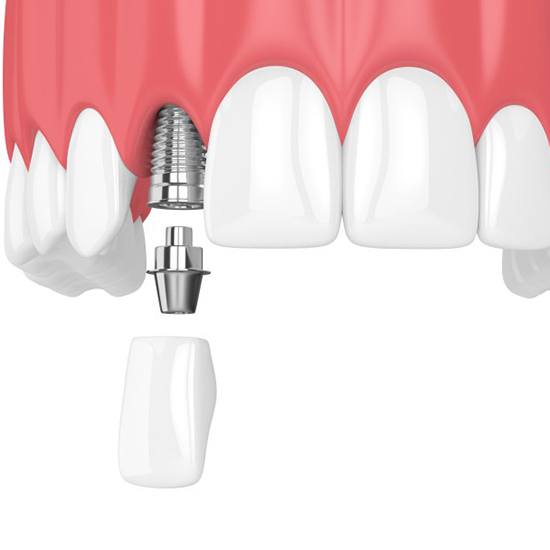 illustration of a dental implant in Arvada replacing a single missing tooth 