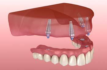 Digital diagram of implant dentures in Arvada