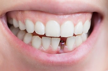 close-up of a person with a visible dental implant abutment smiling 