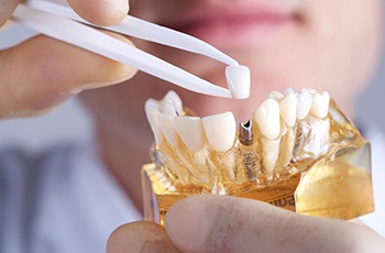 dentist placing a crown onto a dental implant in a model of the jaw 