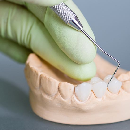 Dental bridge on a model of teeth
