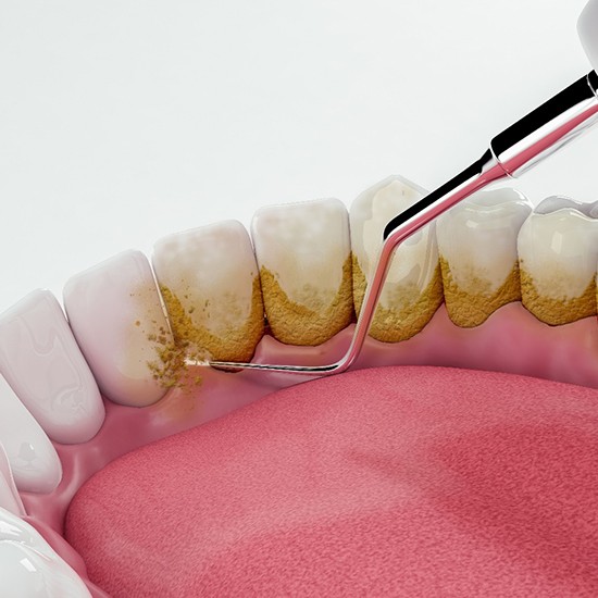 Illustration of dental tool removing plaque