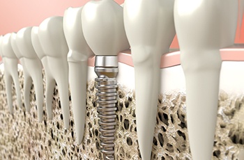 Digital illustration of a dental implant