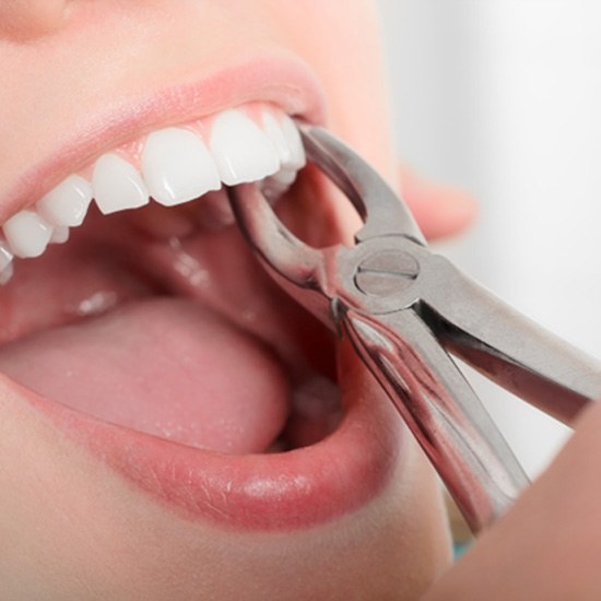 Forceps grabbing onto a dental patient’s infected tooth