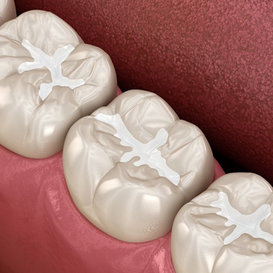 3D render of a dental filling