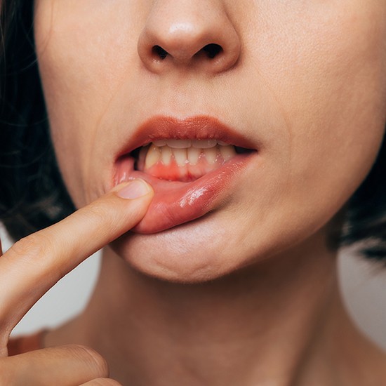 Woman pulling down lips to show signs of gum disease in Arvada, CO