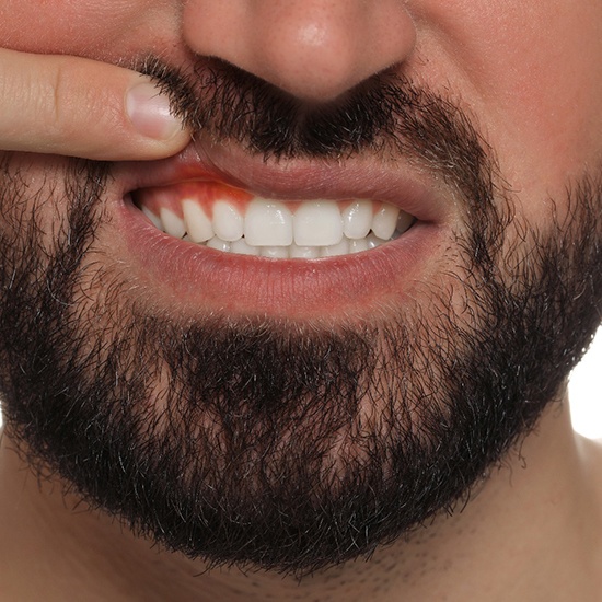 Bearded man pulling up lip to show signs of gum disease