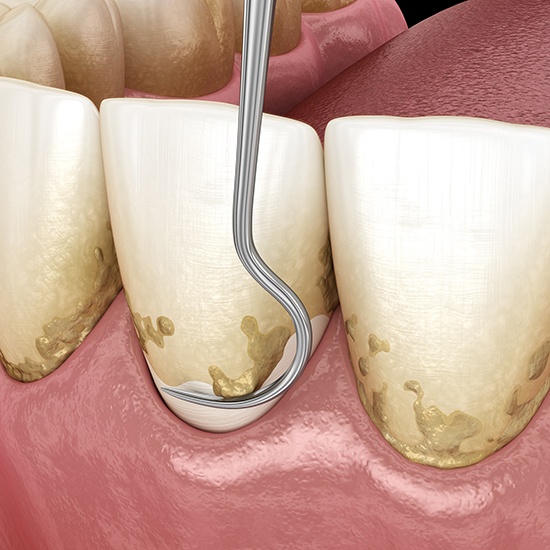 Illustration of plaque being removed from teeth during scaling and root planing
