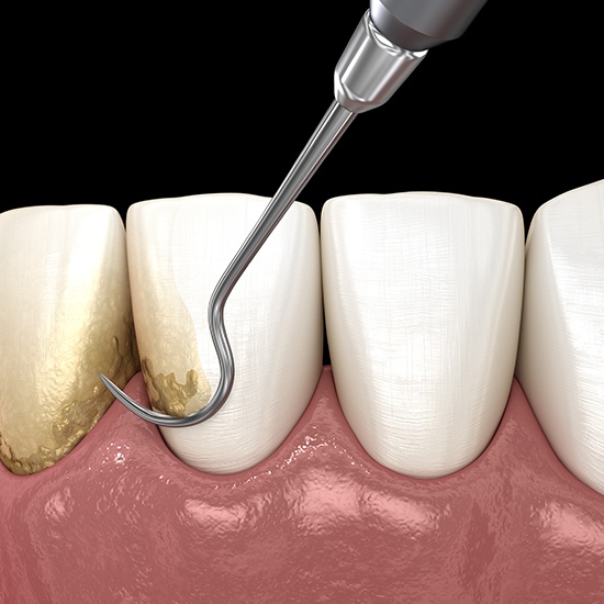 Animated scaling and root planing periodontal therapy