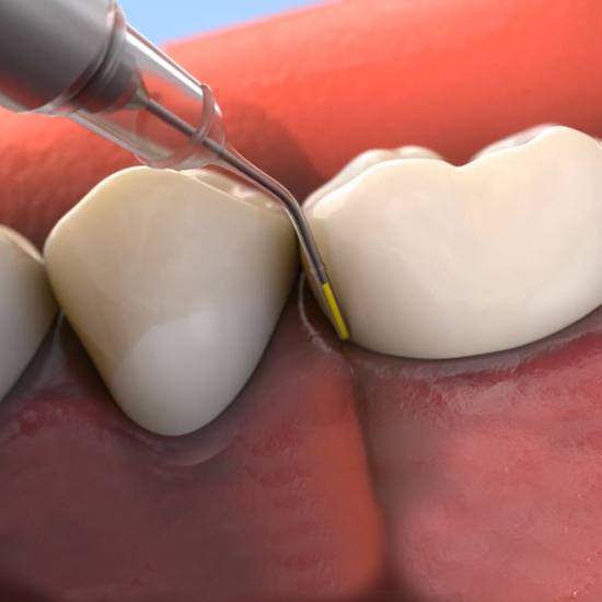 Animated topical antibiotic treatment for gum disease