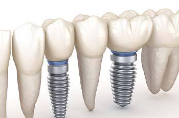 Dental implant bridge in Arvada