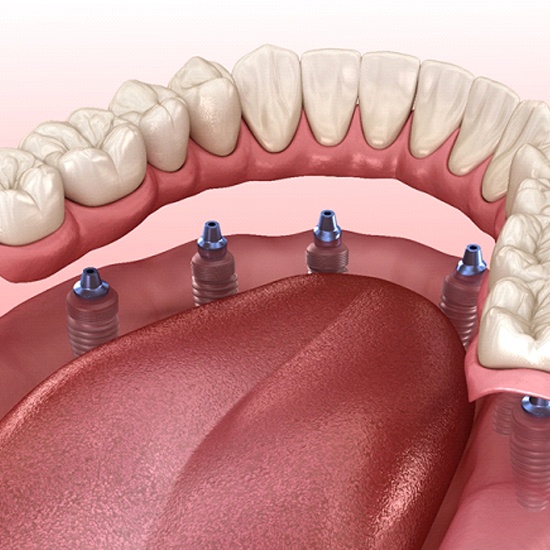 Diagram of denture hovering over dental implants in Arvada