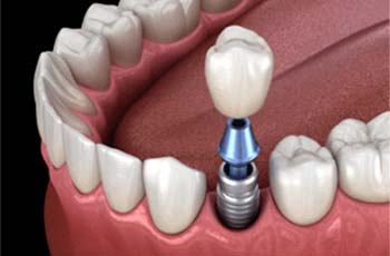 Dental implant in Arvada
