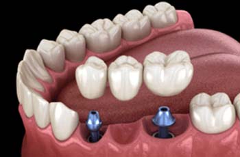 Implant bridge in Arvada