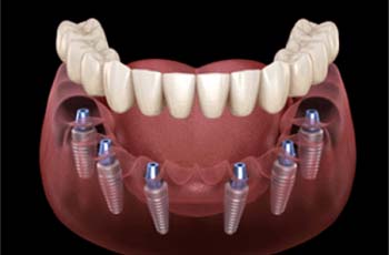Implant denture in Arvada