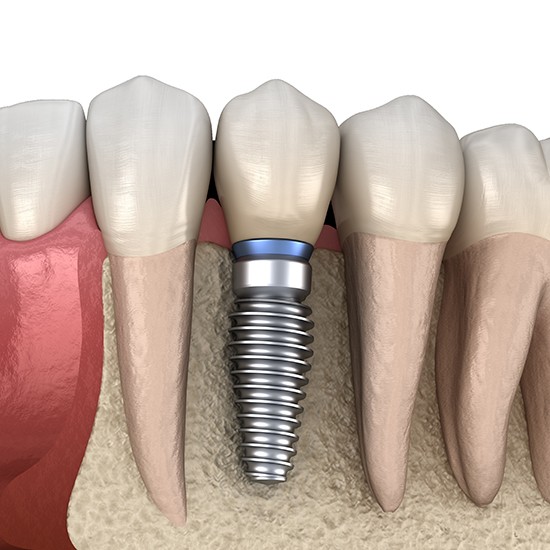 Animated dental implant supported replacement tooth