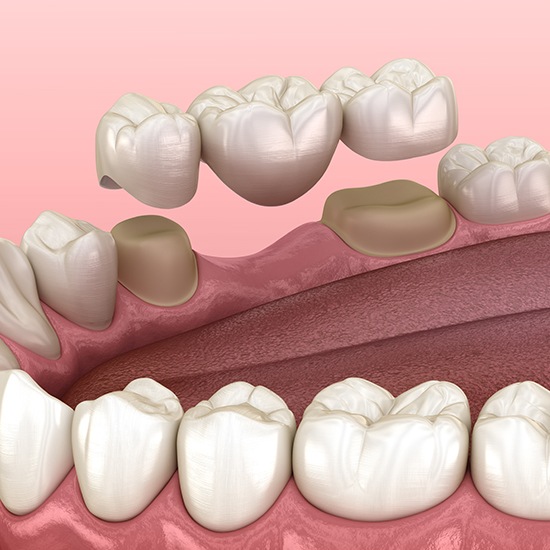 Animated dental bridge placement