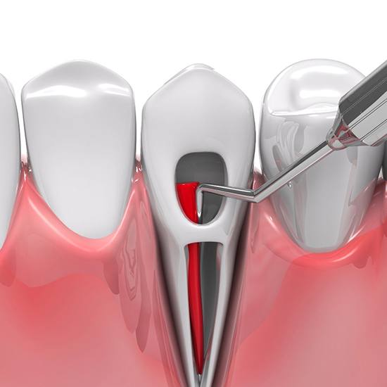 Illustration of tooth being treated with root canal therapy in Arvada, CO