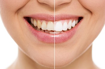 Woman split between before and after whitening treatment