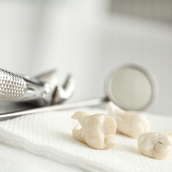 Closeup of teeth on white background after wisdom tooth extraction in Arvada